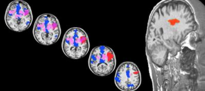 Brainscans showing anterior and posterior insula